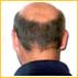 What is Alopecia?