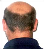 What is Alopecia?