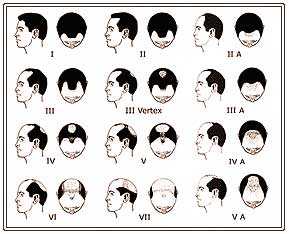 Diagrammatic representation of Male Pattern Baldness