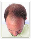 Male pattern thinning