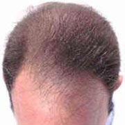 Male Pattern Baldness 101
