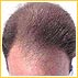 Male Pattern Baldness 101
