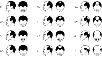 Male Pattern Baldness